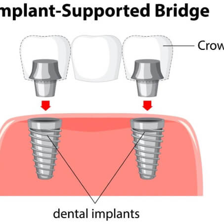 Dental Implants 4