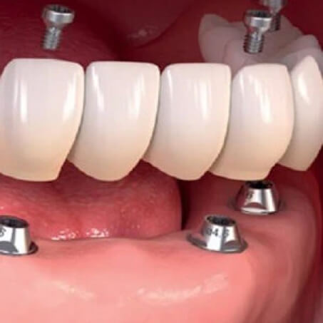 Dental Implants 5